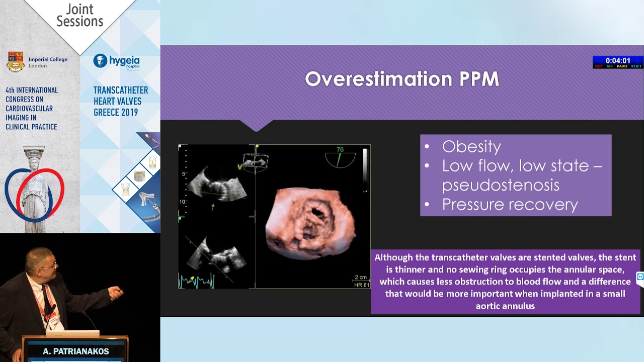 A. Patrianakos | Patient-prosthesis mismatch after transcatheter aortic valve replacement