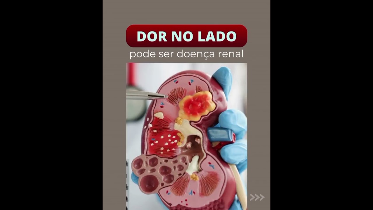 Dor no lado do corpo pode ser doen&ccedil;a renal?