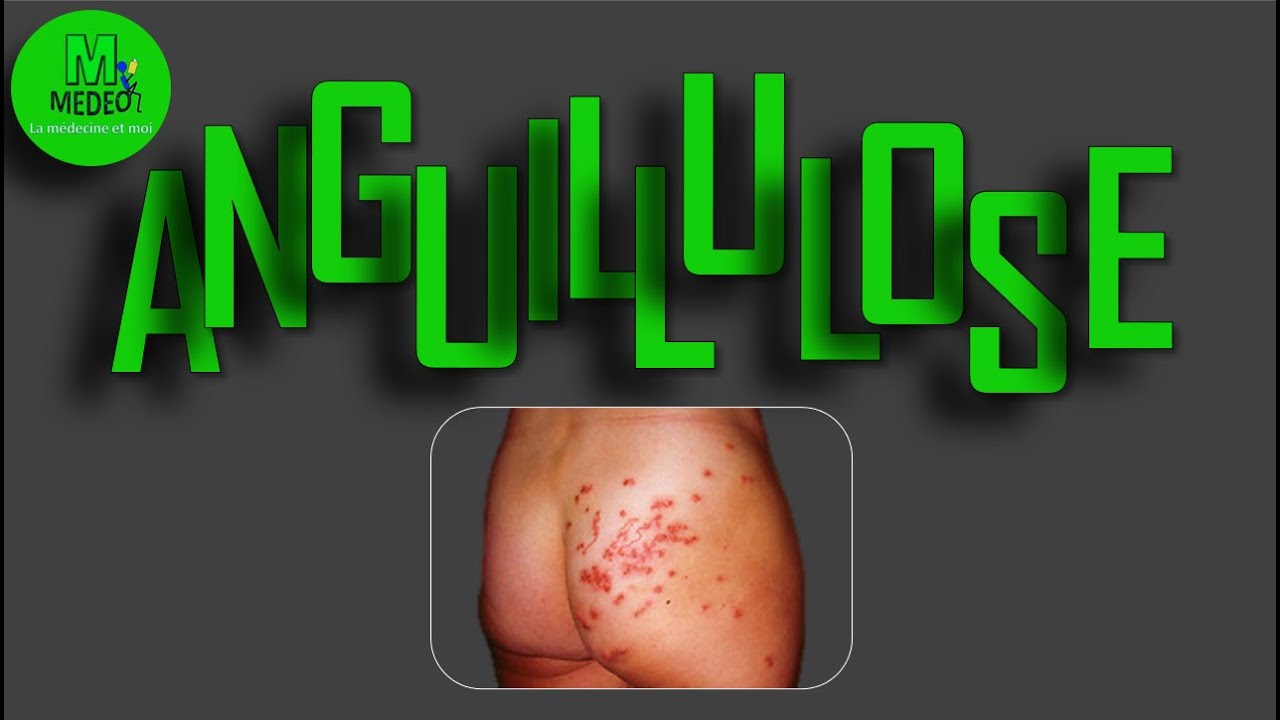 ANGUILLULOSE / STRONGUILOÏDOSE : cours de parasitologie médicale
