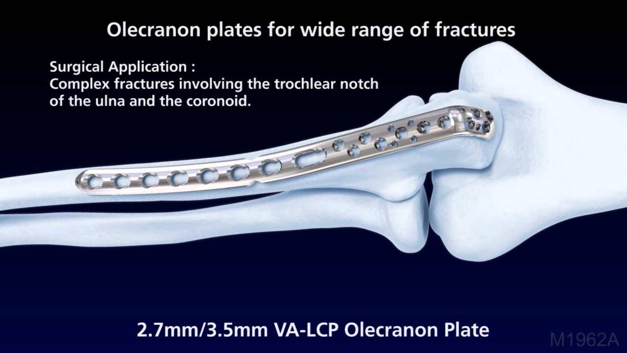 LCP-VA Elbow System