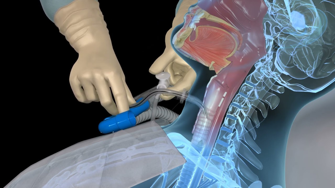 Открытая аспирация с помощью трахеостомической трубки — 3D-анимация