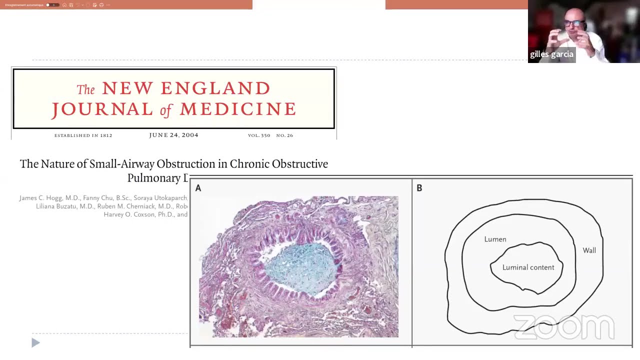 Est-ce de l'asthme ou une BPCO ?