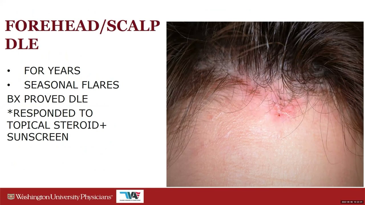 Skin of Color 2022 Presentation: Cutaneous Lupus Across Skin Tones