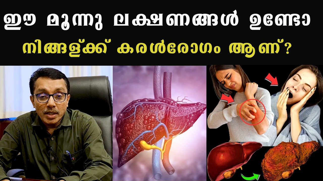 ഈ മൂന്നു ലക്ഷണങ്ങൾ ഉണ്ടോ നിങ്ങള്ക്ക് #കരൾരോഗം ആണ്  ?/ Dr  Biju Ik  / Liver