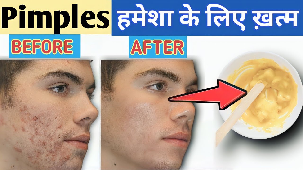 Pimples Removal on Face at Home | Pimple Kaise Hataye | Acne Removal