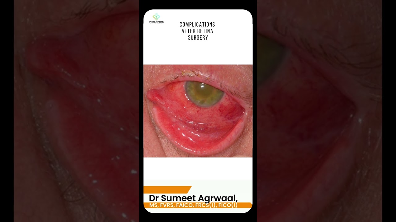 Complications After Retina Surgery | Dr. Sumeet Explains 👁️