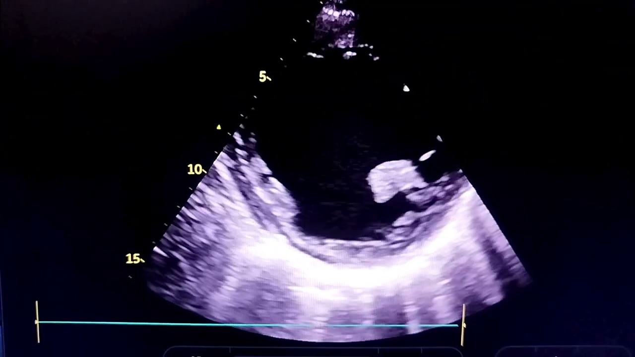 Dilated Cardiomyopathy, Severe MR, Severe TR ,AR, Severely Reduced Ejection Fraction 