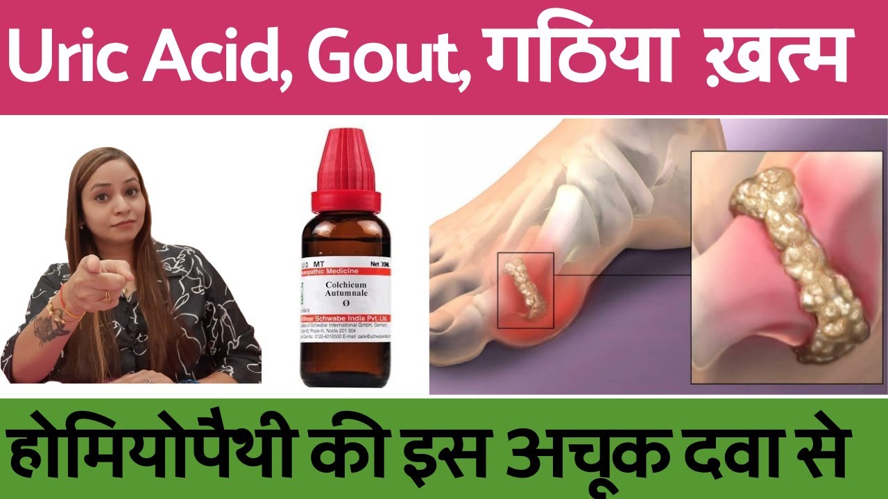 यूरिक एसिड के लक्षण और बेस्ट इलाज |uric acid, gout kam karne ke upay |uric acid Homeopathic Medicine