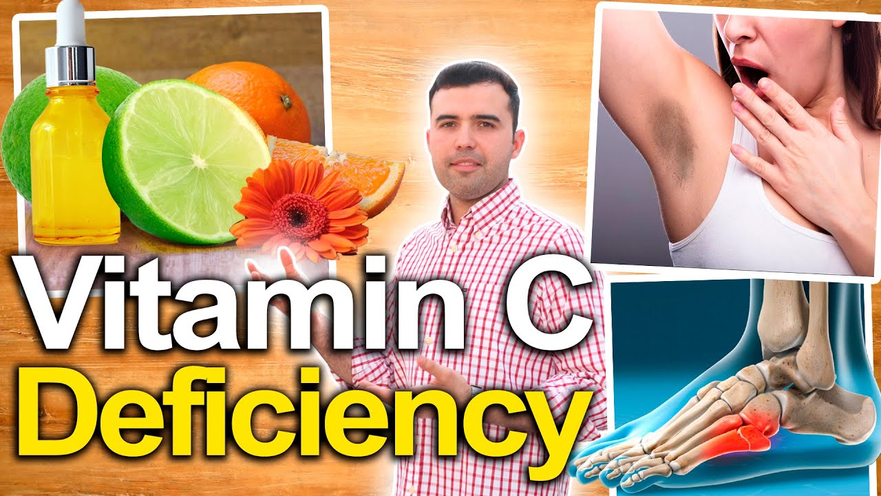 VITAMIN C DEFICIENCY SYMPTOMS