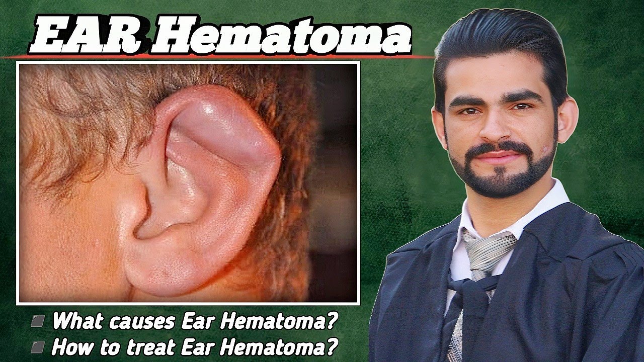 Ear hematoma || causes, treatment, complications