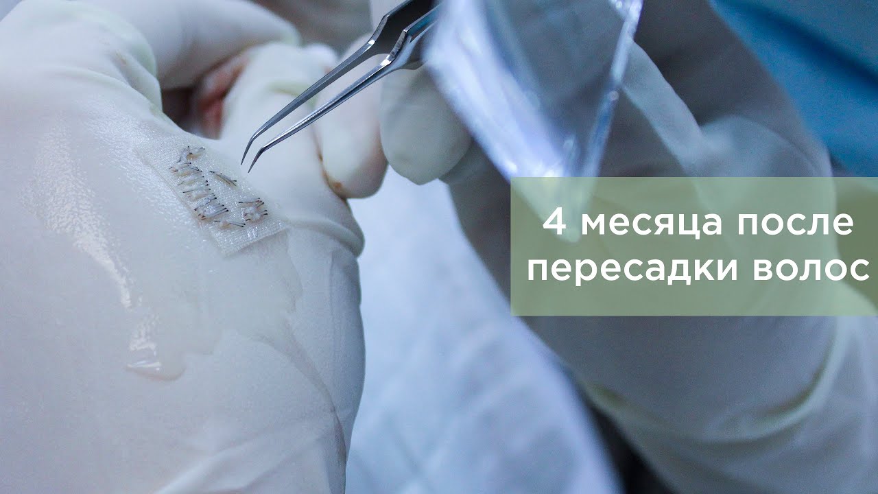 4 месяца после пересадки волос