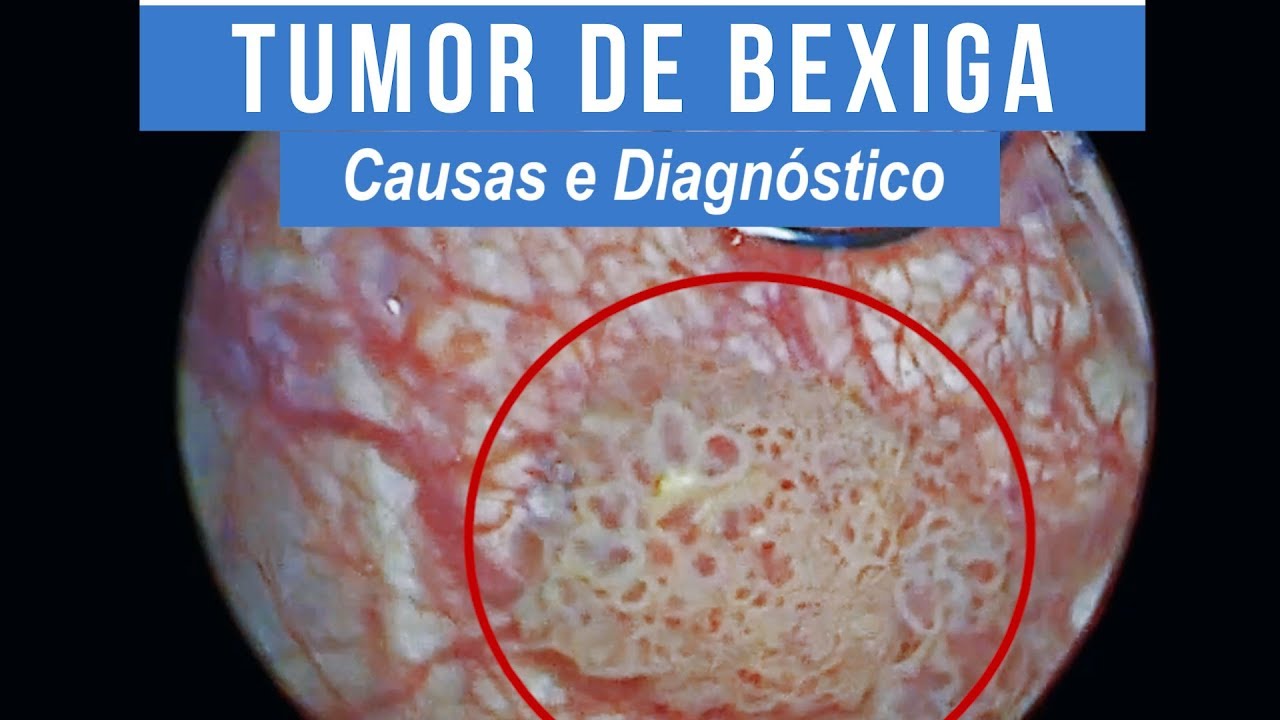 Tumor de Bexiga - Causas e Diagnóstico