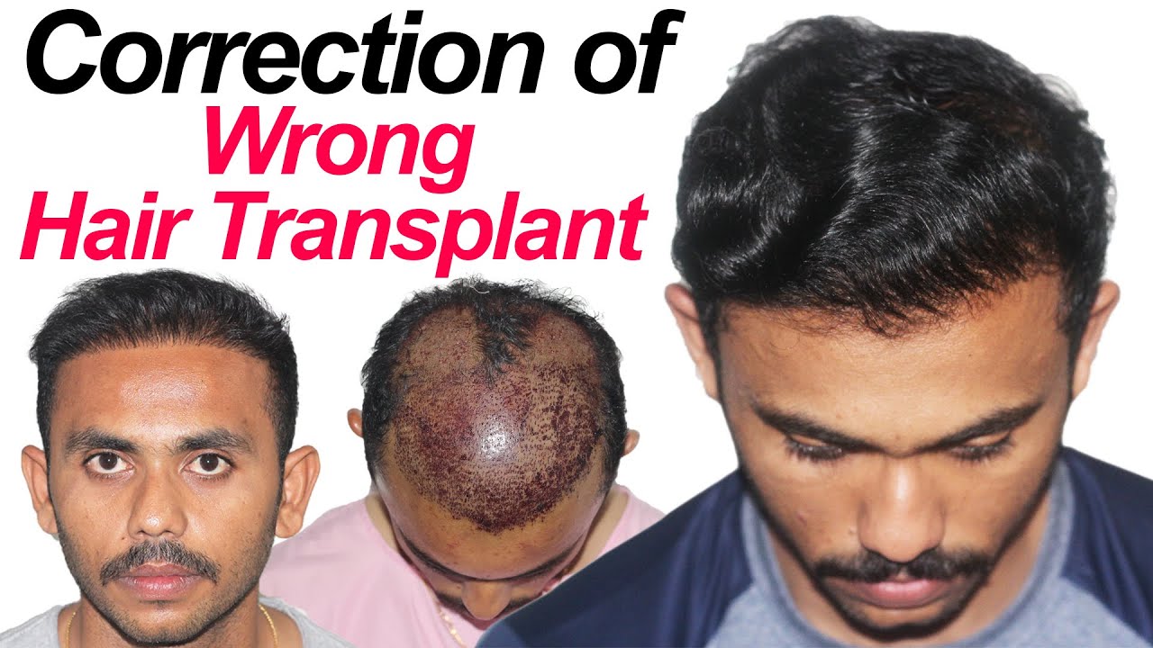Hair Transplant REPAIR in India | Hair Transplant in India Cost | Dr Suneet Soni | Medispa