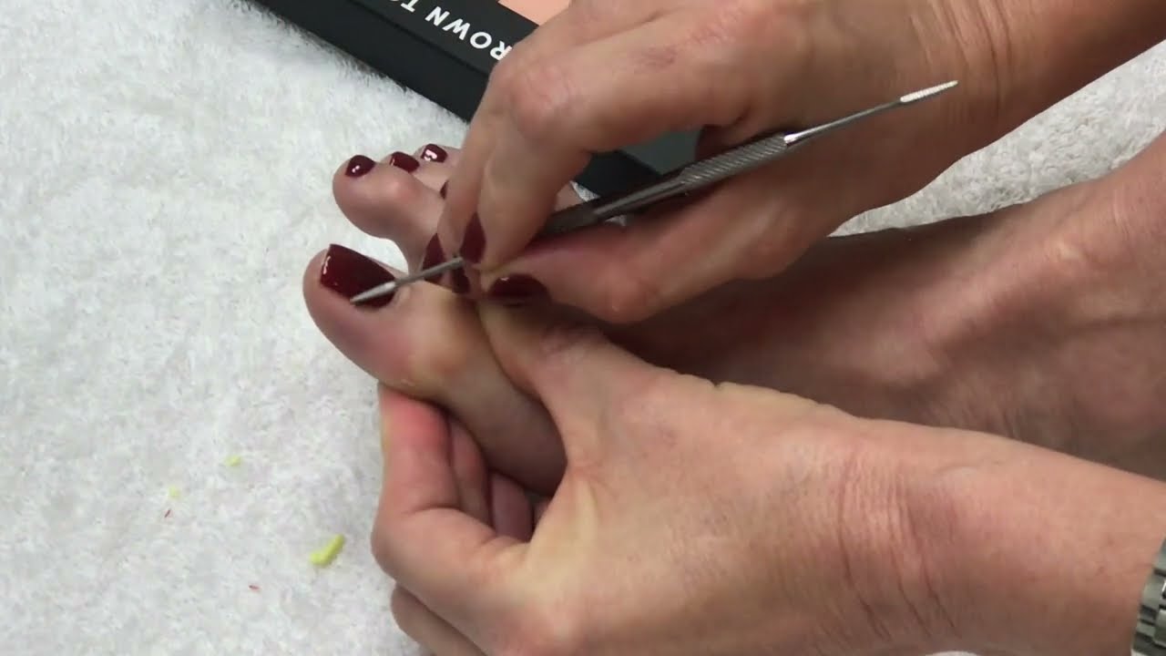 How to fix ingrown toenails at home - Podiatrist explains