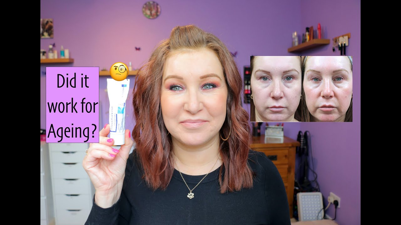 Differin/Adapalene - 6 Months Before & After Review