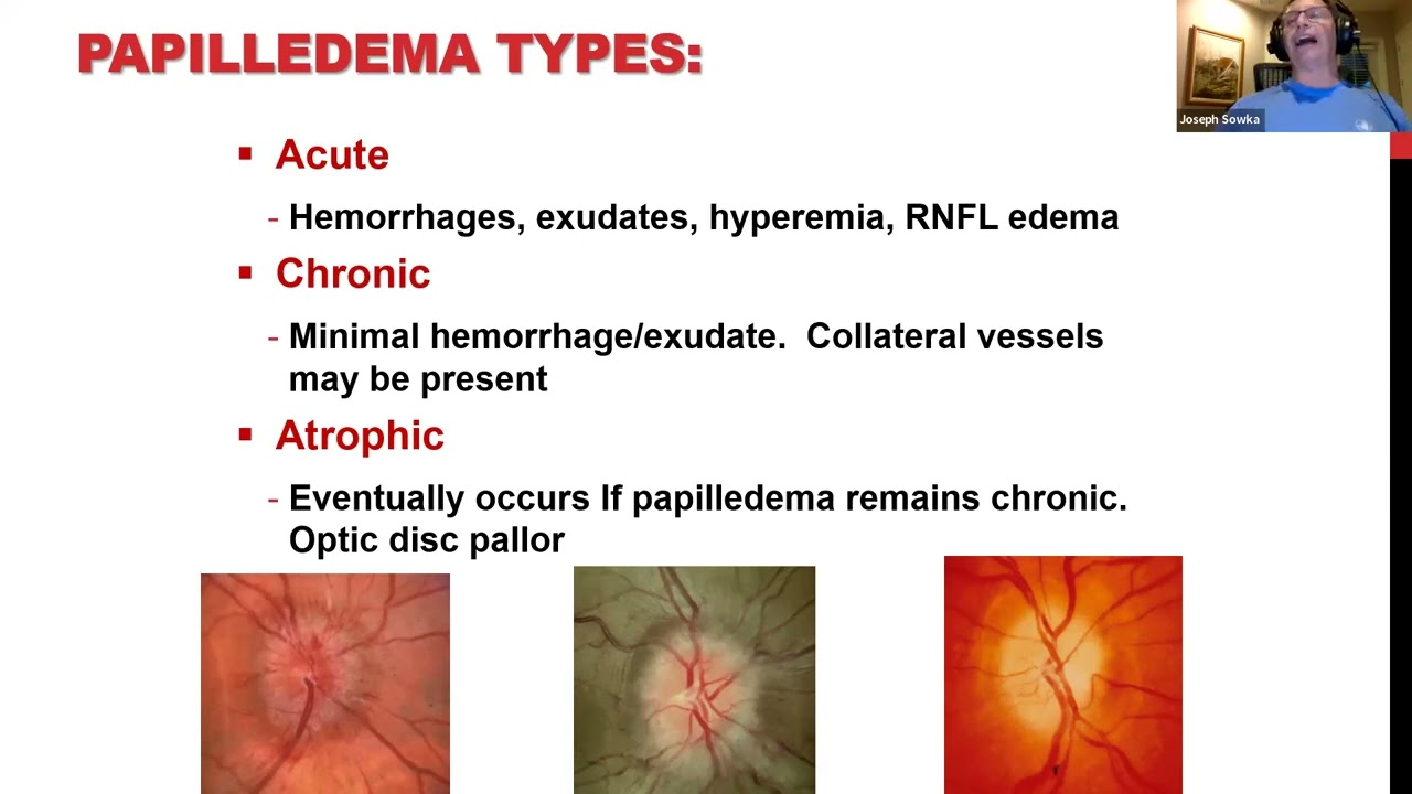 Clinical Grand Rounds in Optic Neuropathies You've Got Some Nerves!