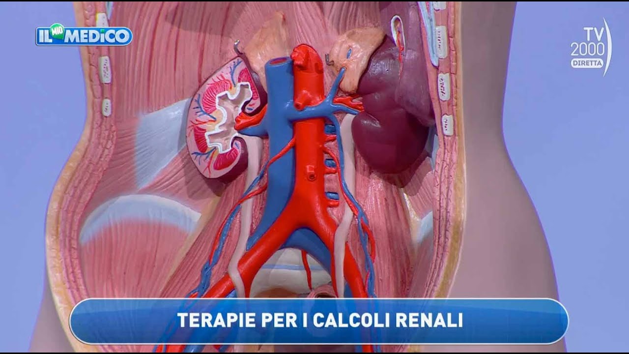 Il Mio Medico (Tv2000) - Nuove tecniche per rimuovere i calcoli renali