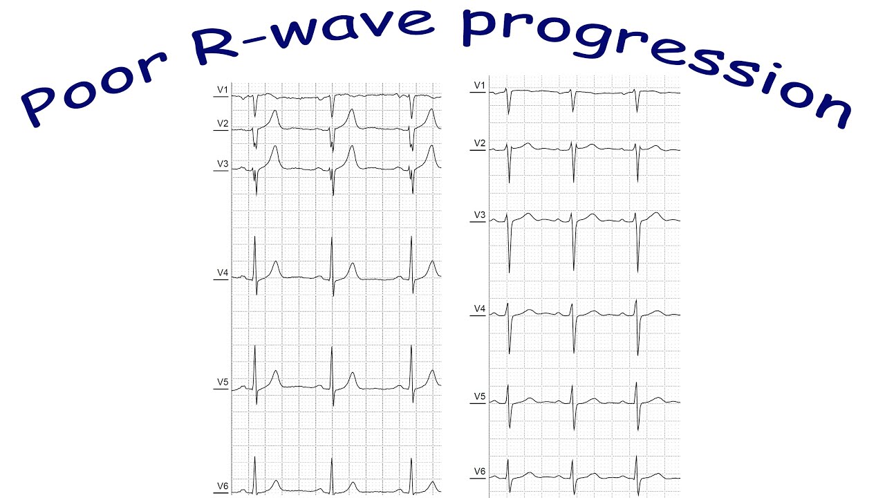 Poor R-wave progression