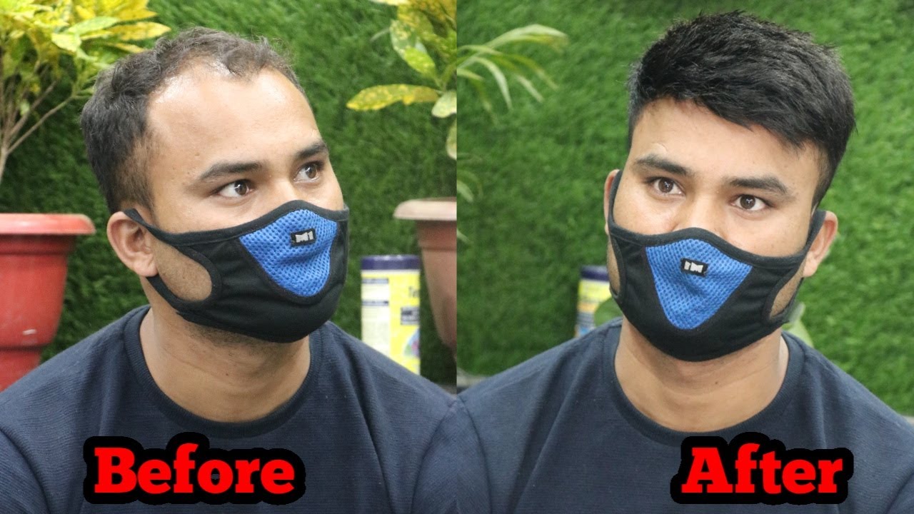Non Surgical Hair Replacement in DELHI | Army Cut Hair Style | Hair Fixing For Men