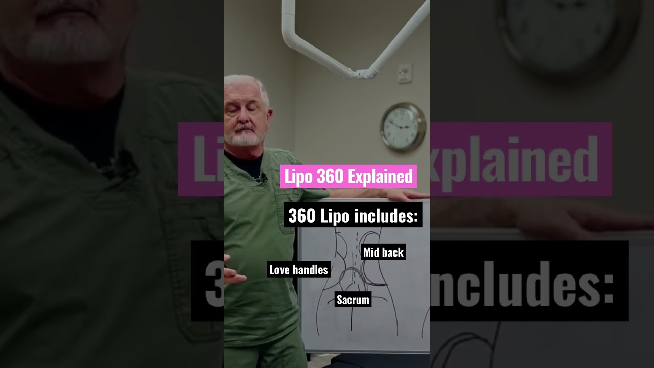What is Lipo 360? Do you need it? #shorts #weightlosstips #cosmeticsurgeon #cosmeticsurgeryclinic