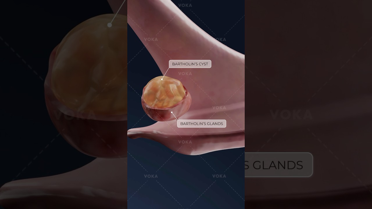 ¿Qué es un quiste de Bartolino y cómo afecta la salud de la mujer? ¡Ginecología en 3D con VOKA!