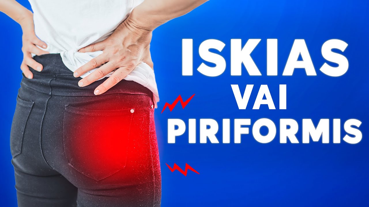 PIRIFORMIS vai ISKIAS? Kuinka tunnistan piriformiksen vaivan?