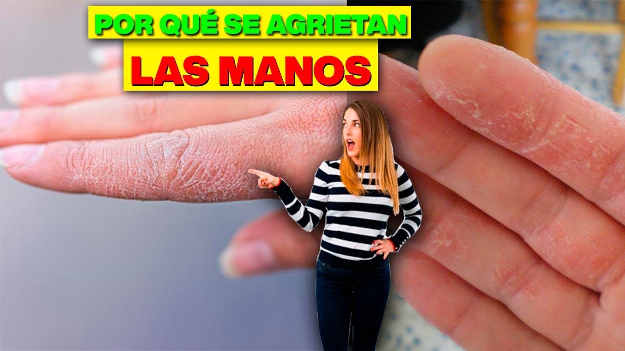 &iquest;C&oacute;mo curar las manos resecas y AGRIETADAS?