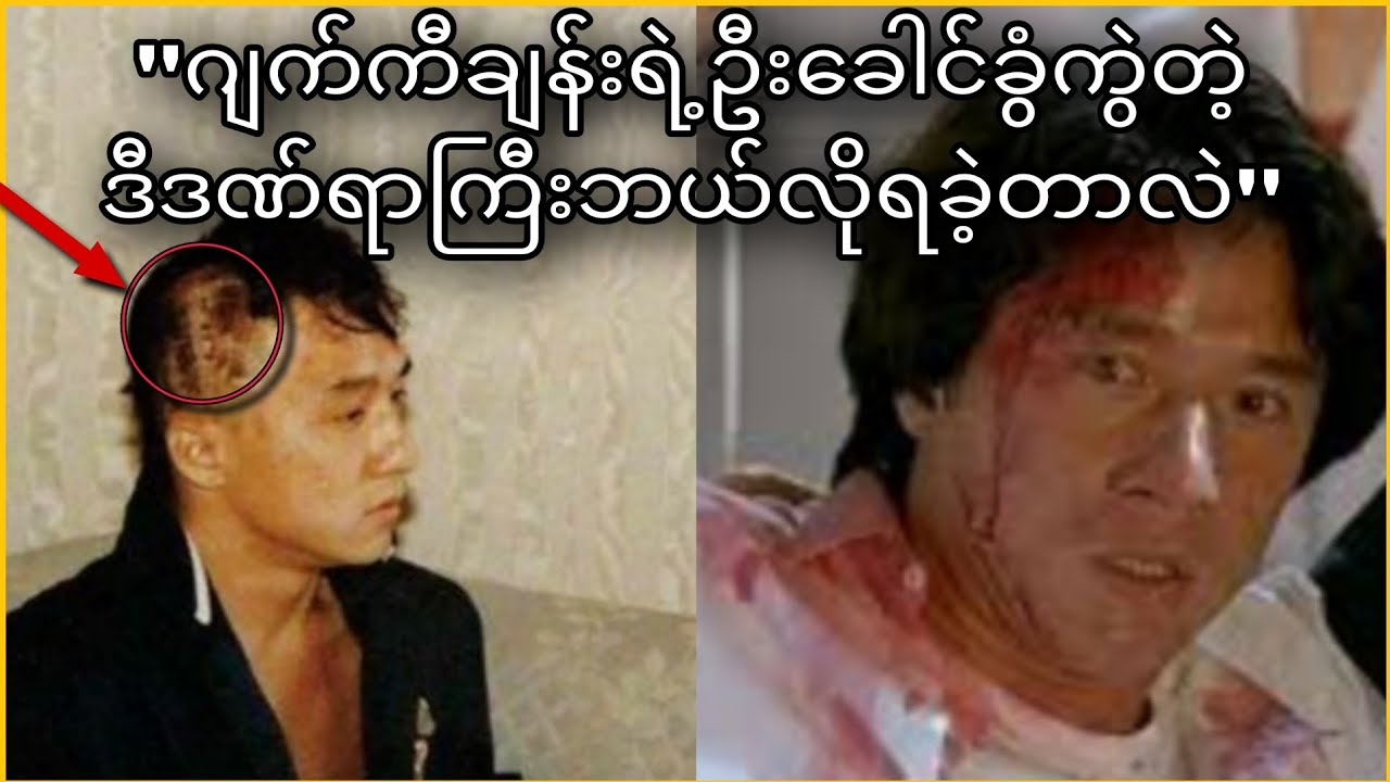 'ဂျက်ကီချန်းရဲ့ဦးခေါင်းခွံကွဲတဲ့ဒဏ်ရာကြီးဘယ်လိုရခဲ့တာလဲ'How did Jackie Chan get his skull fracture?