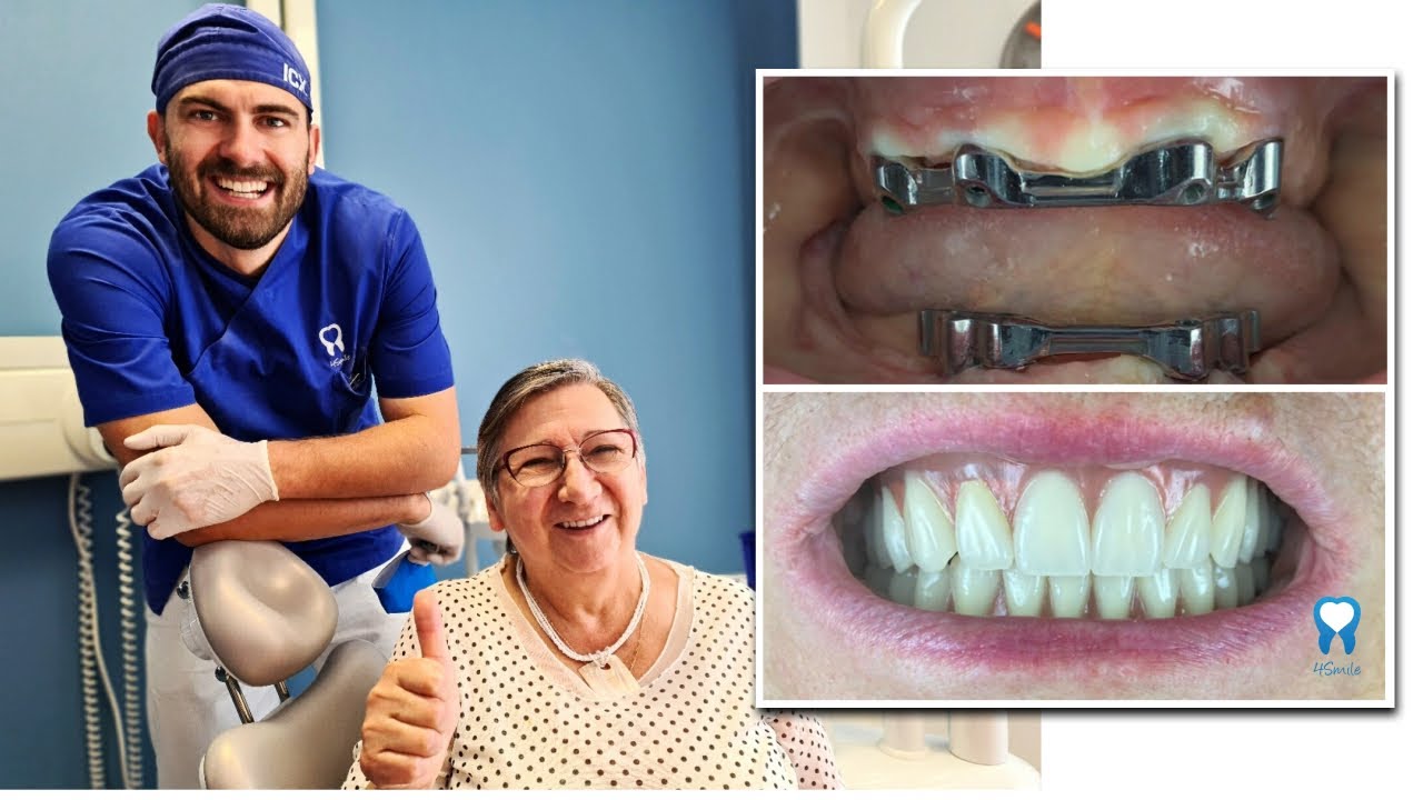 PROTEZA NA 4 IMPLANTATA - Proteza na prečku - Dental Centar 4Smile