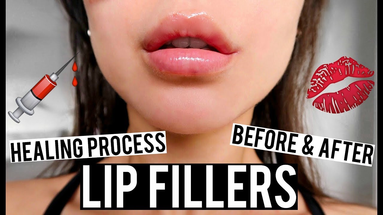 LIP FILLERS BEFORE AND AFTER & HEALING PROCESS VLOG | KatesBeautyStation
