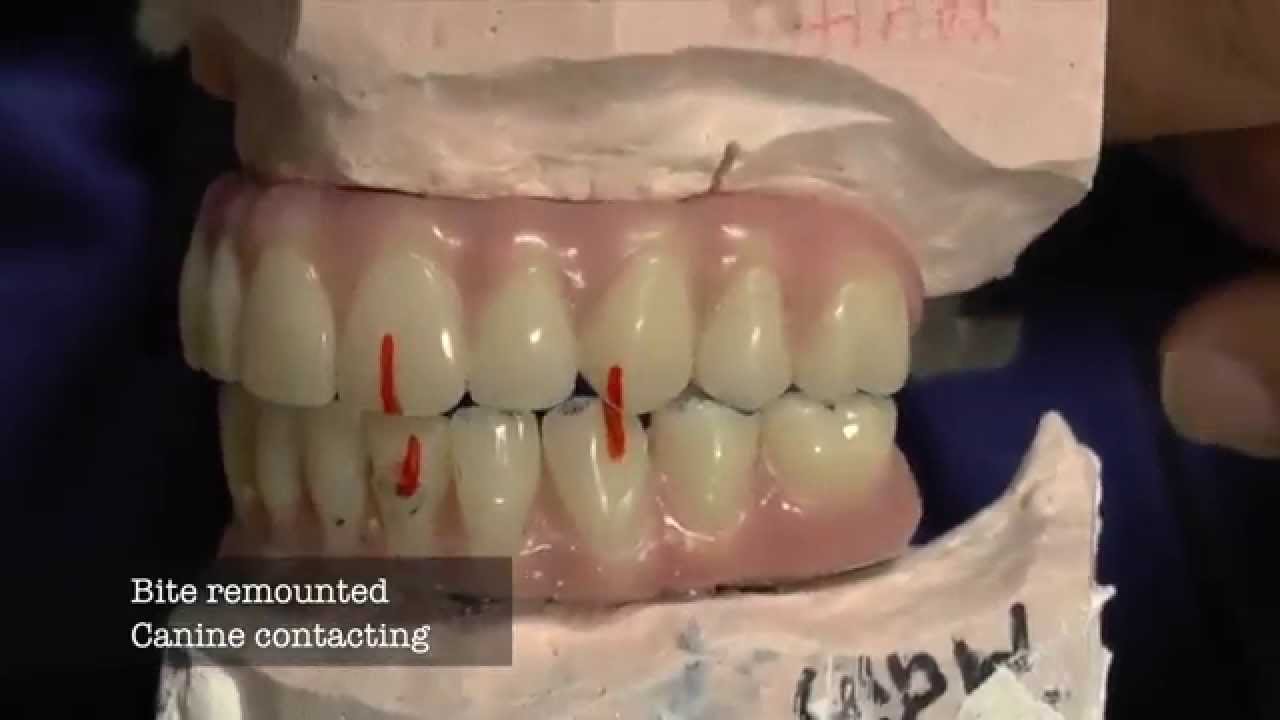 Dental Implant - 