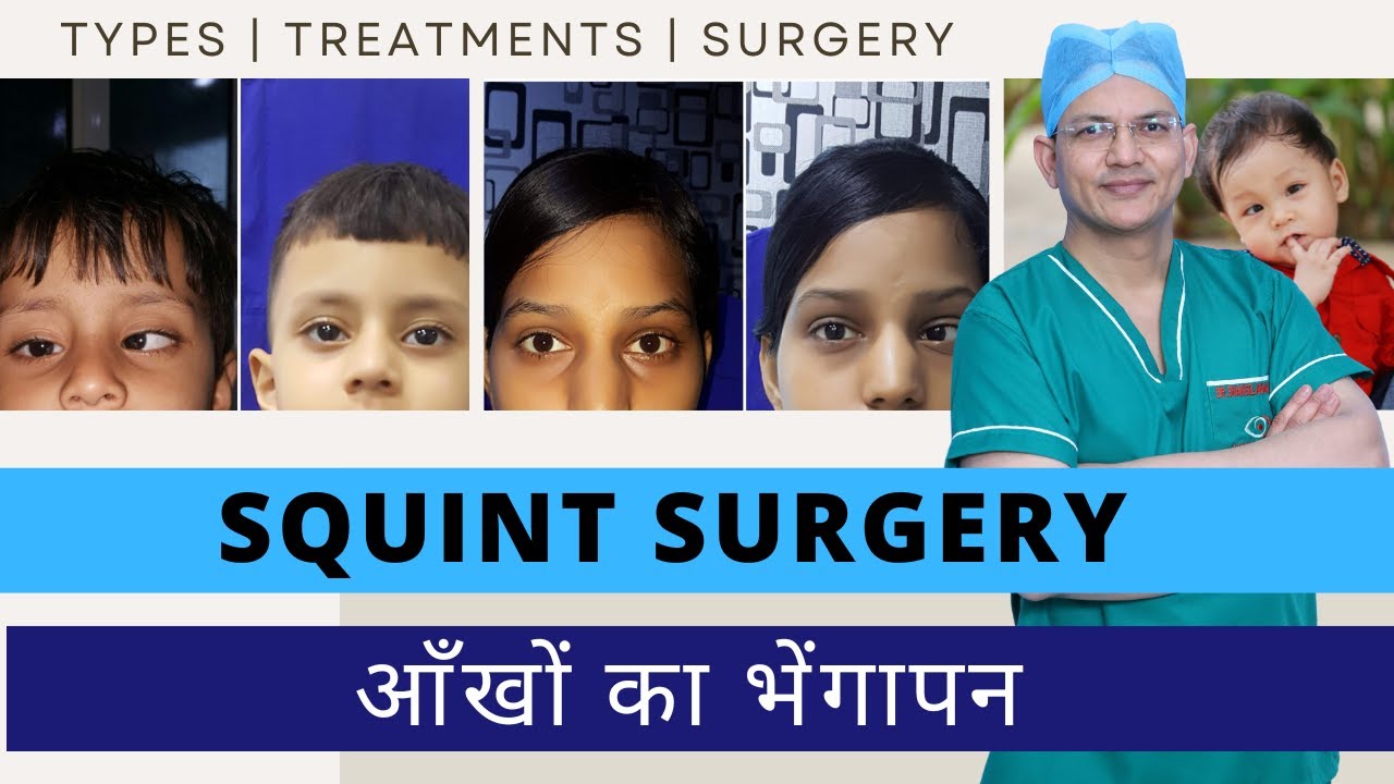 SQUINT TREATMENT-भेंगापन से छुटकारा | STRABISMUS permanent Cure | Squint Exercise for kids, Surgery