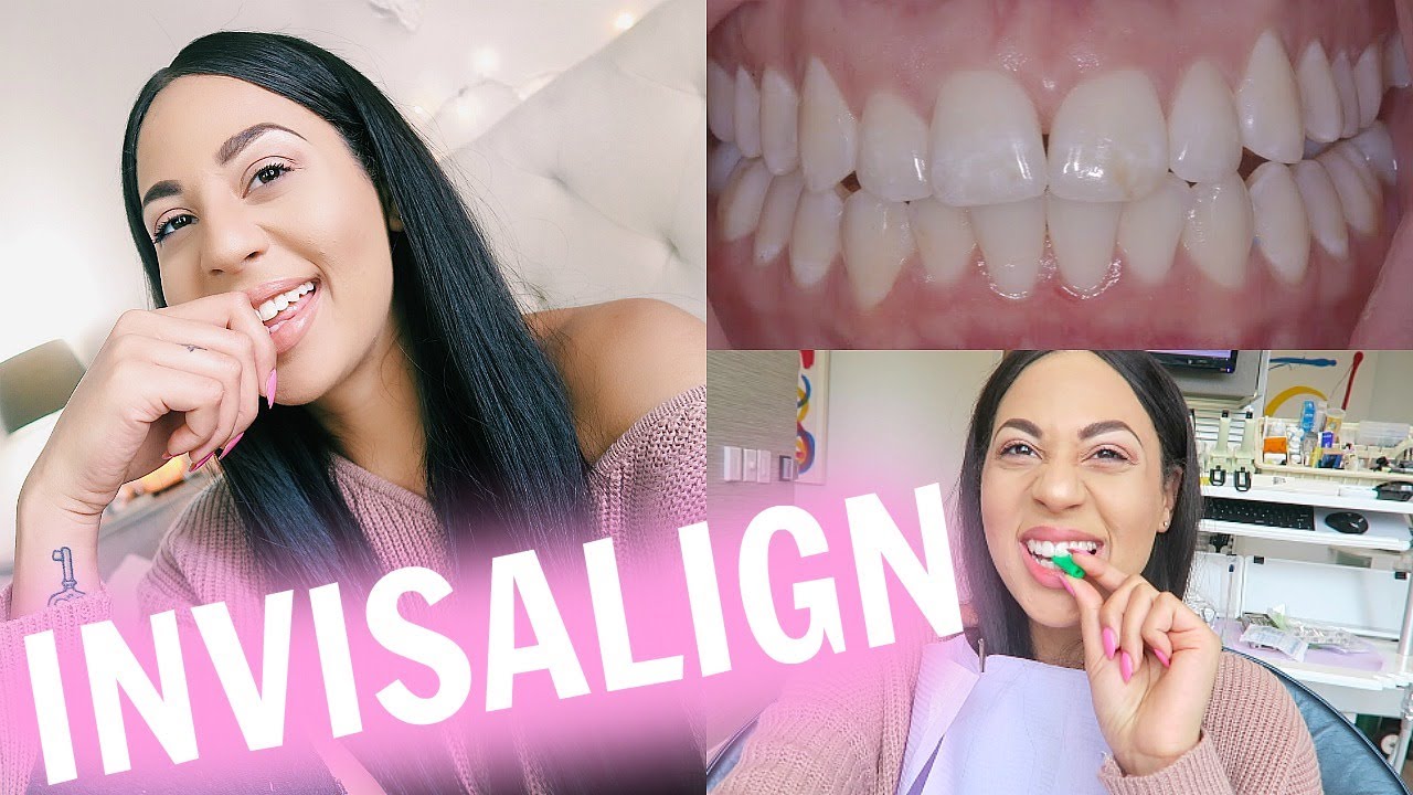 My Invisalign Experience!