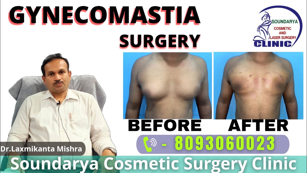 Gynecomastia surgery at Soundarya clinic patients Feedback video/ Dr. Laxmikanta Mishra/