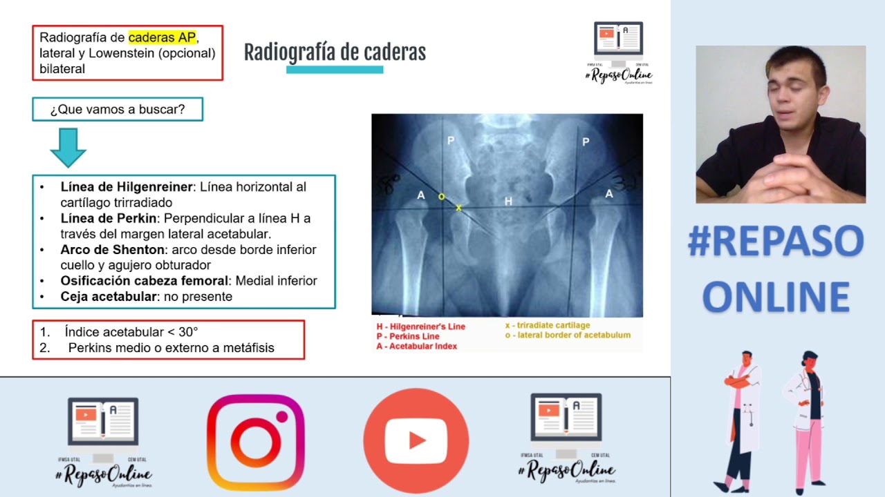 Displasia del desarrollo de la cadera