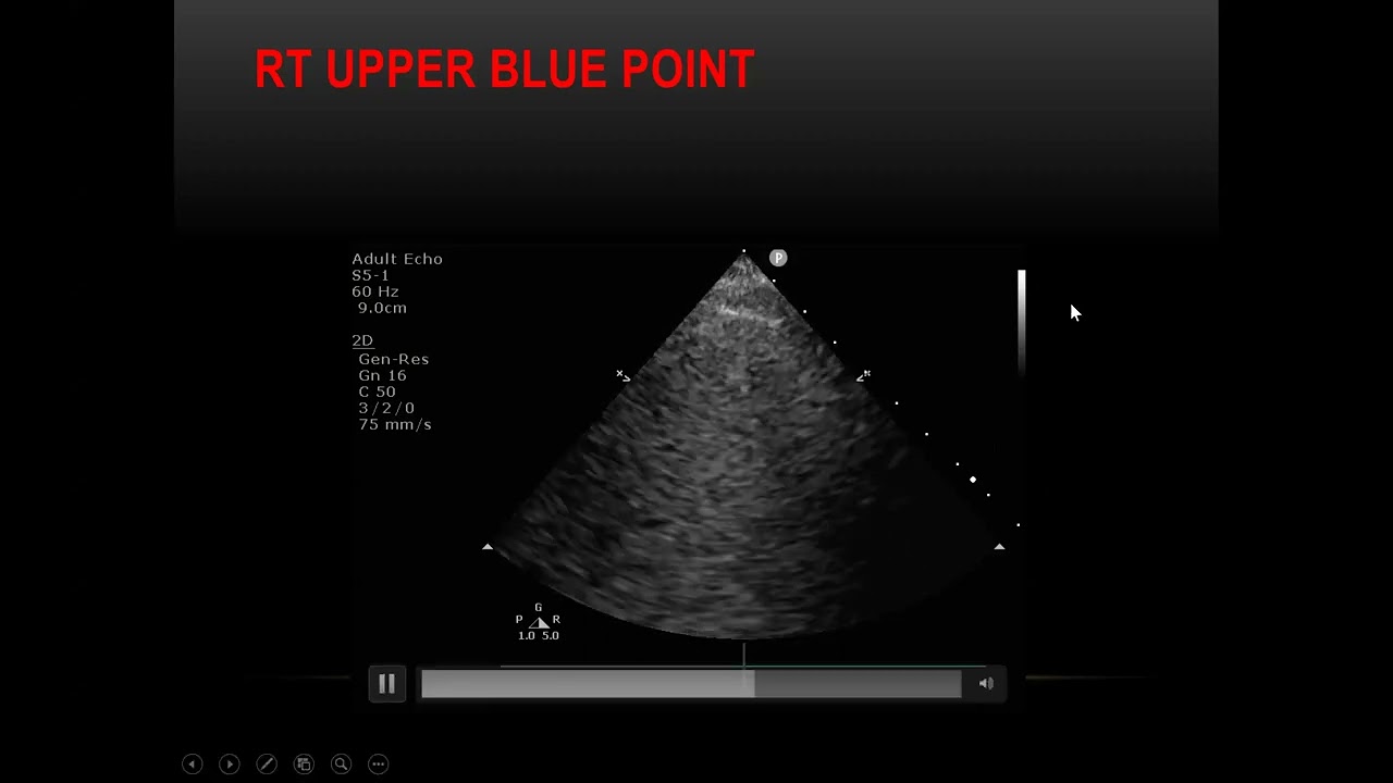 ADVANCED LUNG ULTRASOUND FOR INTENSIVIST