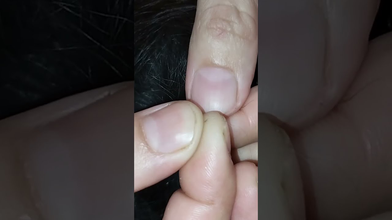 Nitpicking ASMR video 282    #nitpicking #asmr #kuto #piolhos #petantumo #licepicking #catandopiolho