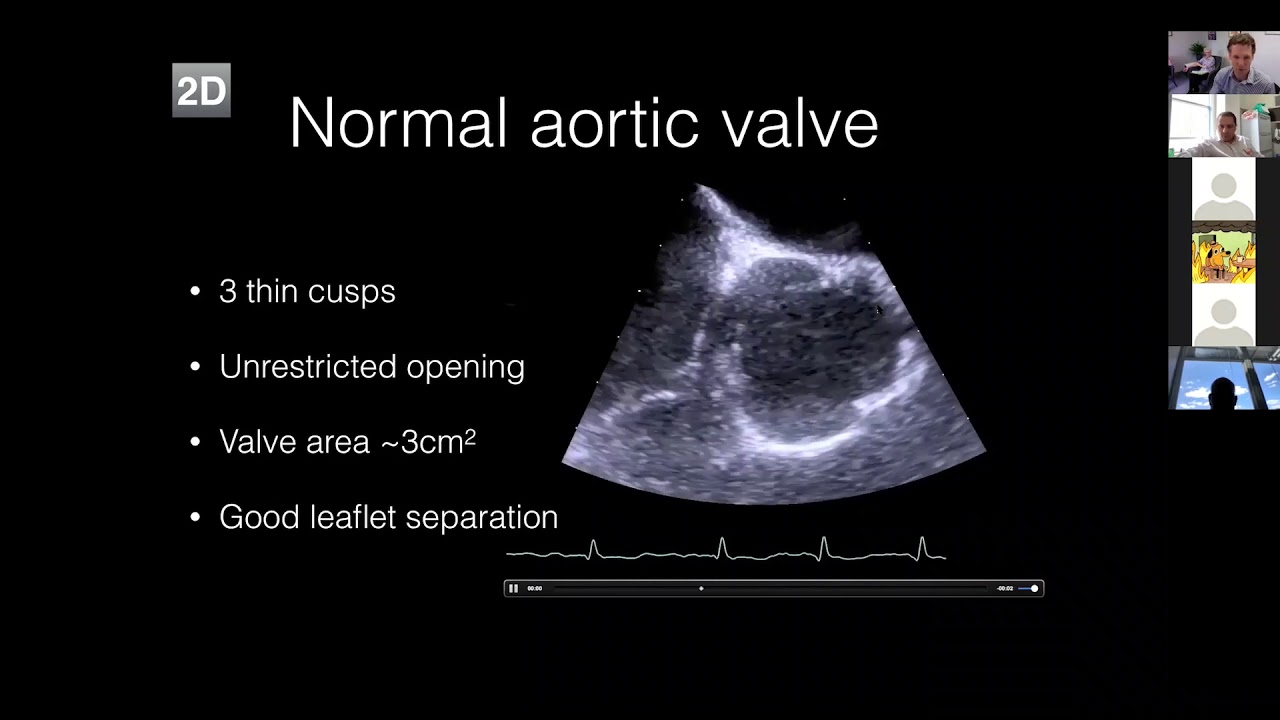 Aortic Stenosis