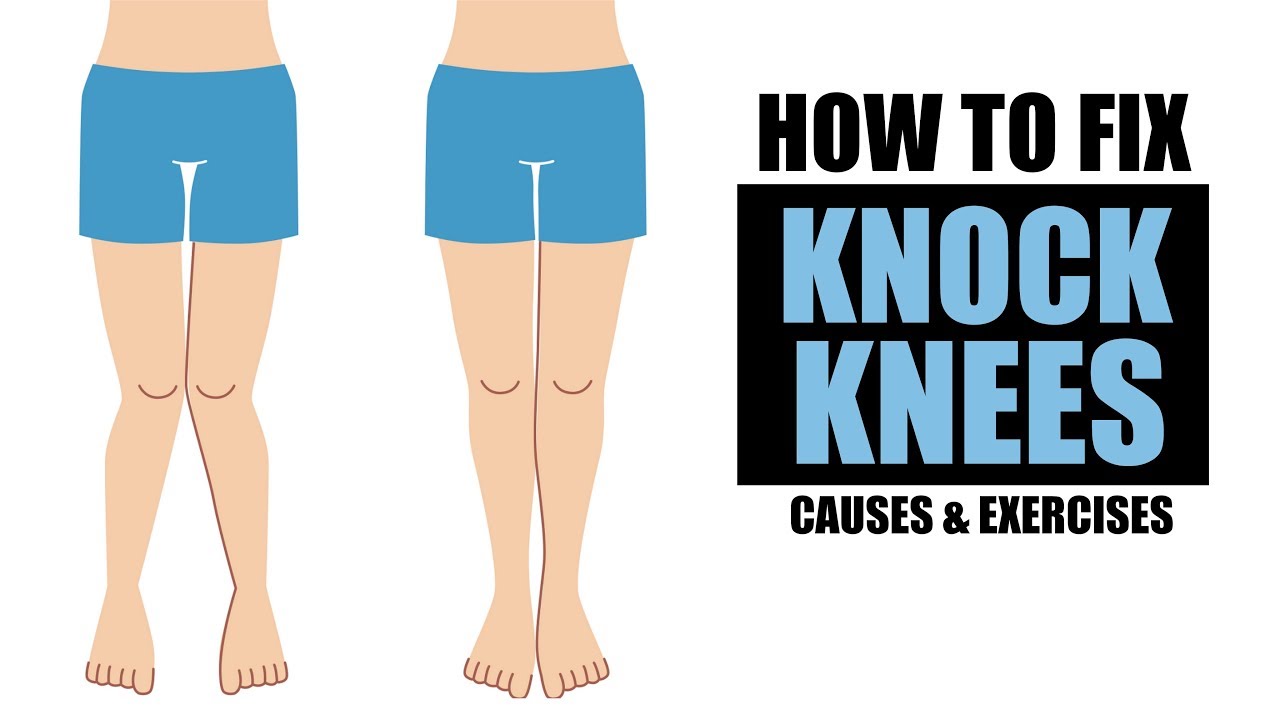 KNOCK KNEE PROBLEM | How to Fix | Info by Guru Mann