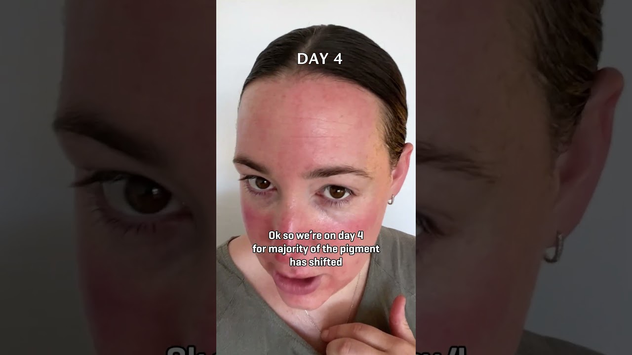 Лазерная терапия Fraxel в Сиднее | Ежедневный прогресс