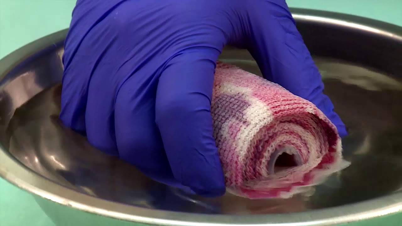 Reduction Fracture using Fiberglass