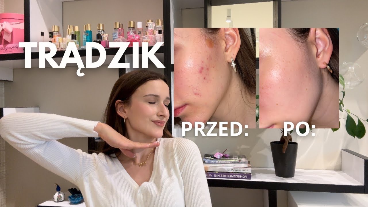 JAK SZYBKO WYLECZYĆ TRĄDZIK??