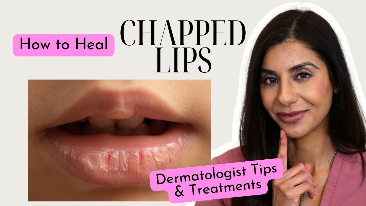 Dermatologist Explains How to Heal Chapped, Dry Lips Fast!
