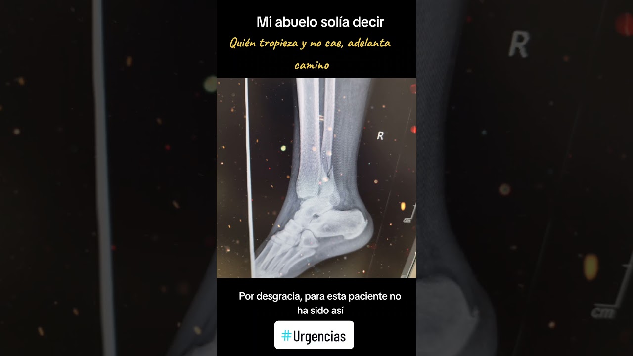 FRACTURA DE PERON&Eacute; 🦵Radiograf&iacute;as que duelen solo al verlas 🤯