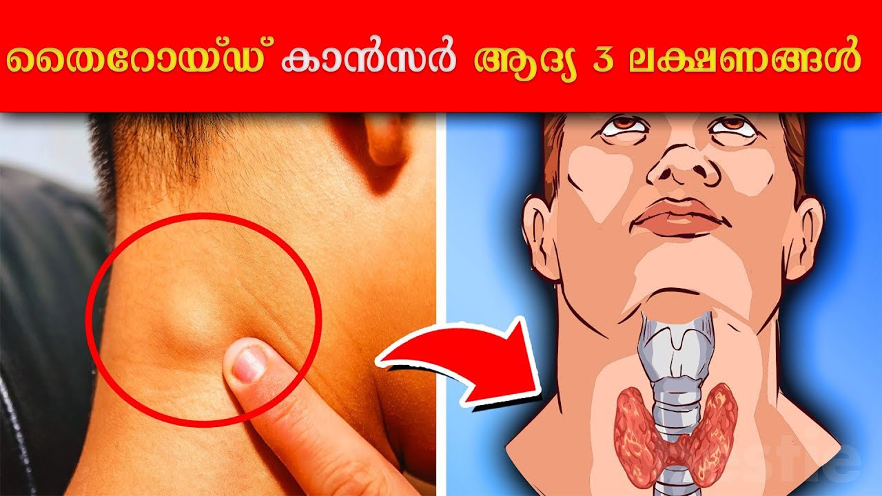തൈറോയ്ഡ് കാൻസർ ആദ്യ മൂന്നു ലക്ഷണങ്ങൾ Thyroid Malayalam