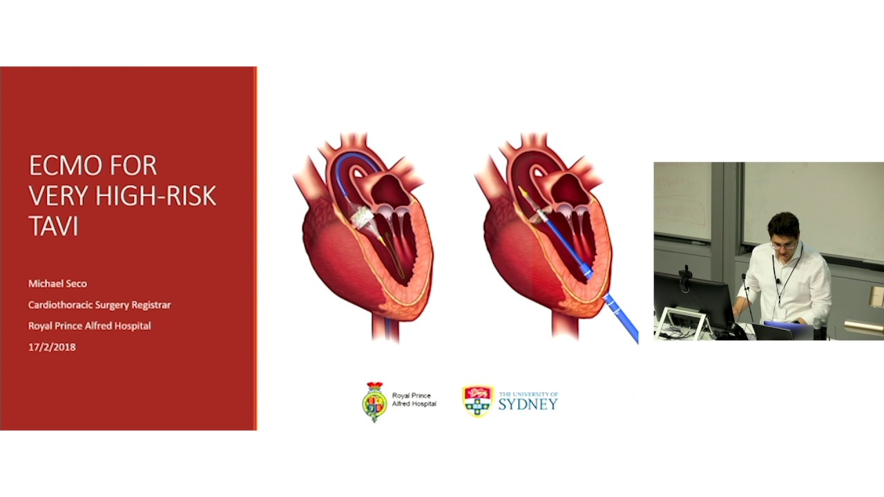 ECMO for Very High-Risk TAVI - Dr Michael Seco