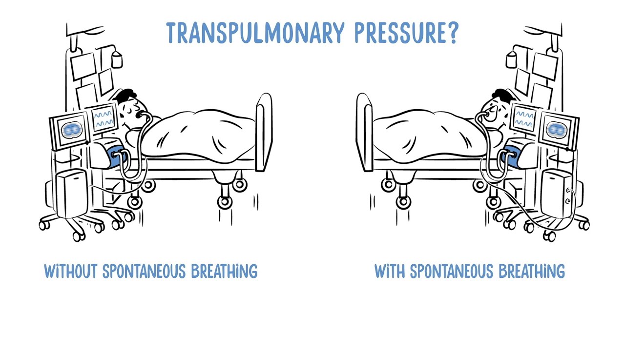 Transpulmonary Pressure Monitoring by Dräger
