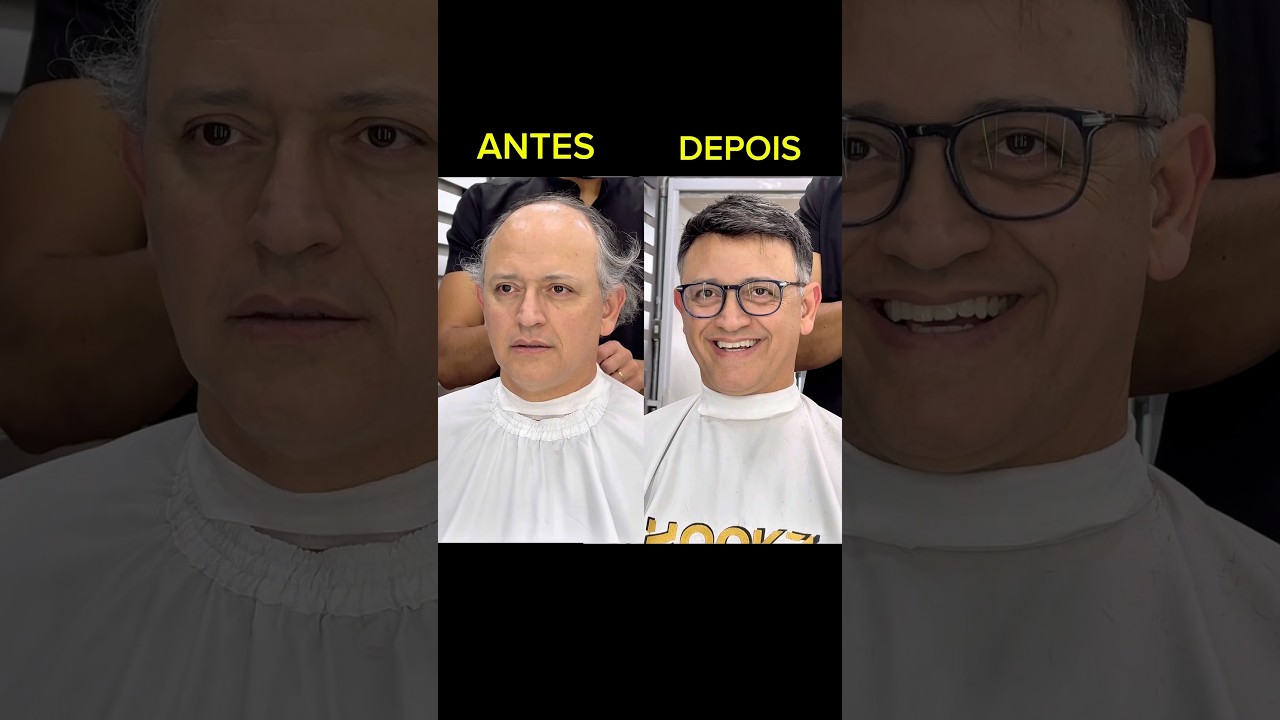 TRANSFORMA&Ccedil;&Atilde;O 😱 #calviciemasculina #protesecapilar #homens #calvicie