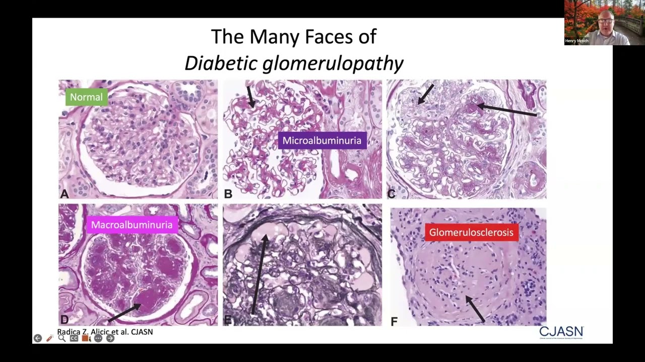 Update in Nephrology 2025: Getting to the Heart of Kidney Disease