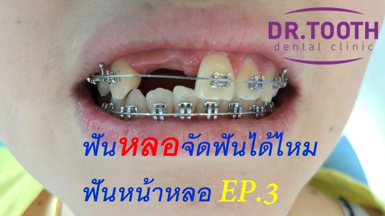 ฟันหลอจัดฟันได้มั้ย,ฟันหน้าหลอแล้วจะจัดฟันกันยังไง EP. 3 #จัดฟันที่ไหนดี 